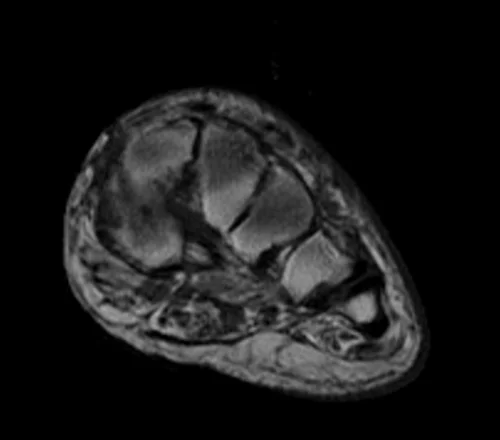 MRI FOOT AXIAL T1 IMAGE 3 - MRI