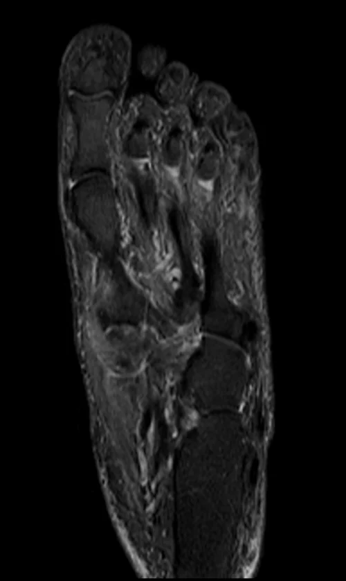 MRI FOOT CORONAL STIR IMAGE 1 - MRI