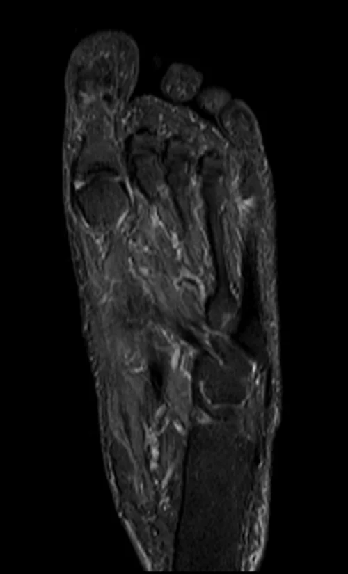 MRI FOOT CORONAL STIR IMAGE 2 - MRI