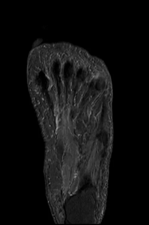 MRI FOOT CORONAL STIR IMAGE 3 - MRI