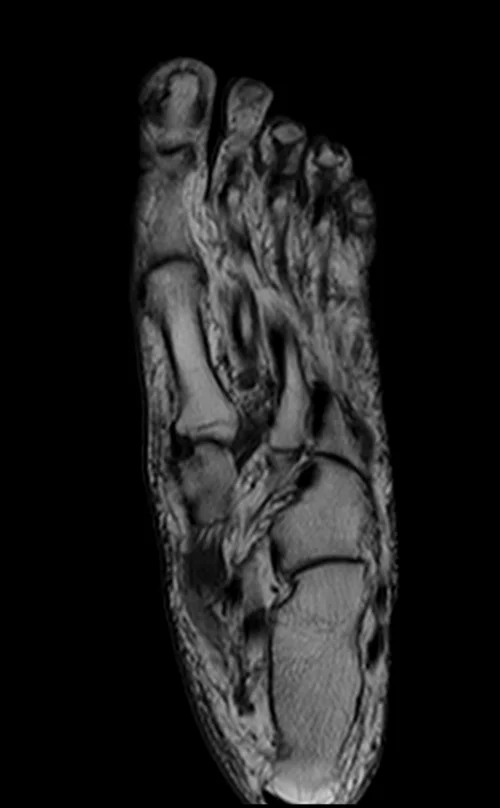 MRI FOOT CORONAL T1 IMAGE 1 - MRI