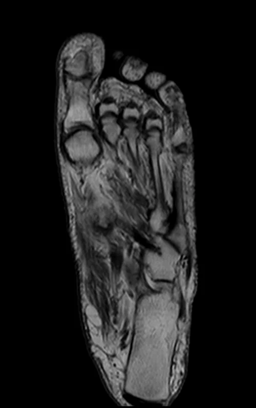 MRI FOOT CORONAL T1 IMAGE 2 - MRI