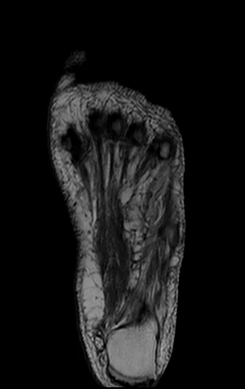 MRI FOOT CORONAL T1 IMAGE 3 - MRI