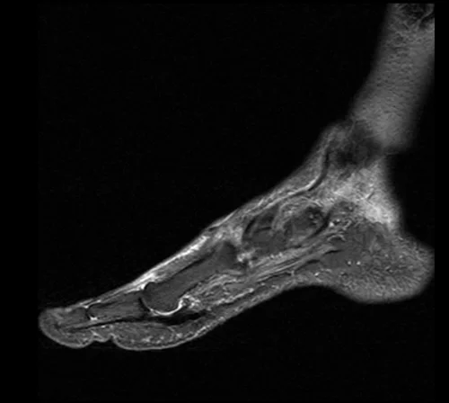 MRI FOOT SAGITTAL STIR IMAGE 1 - MRI