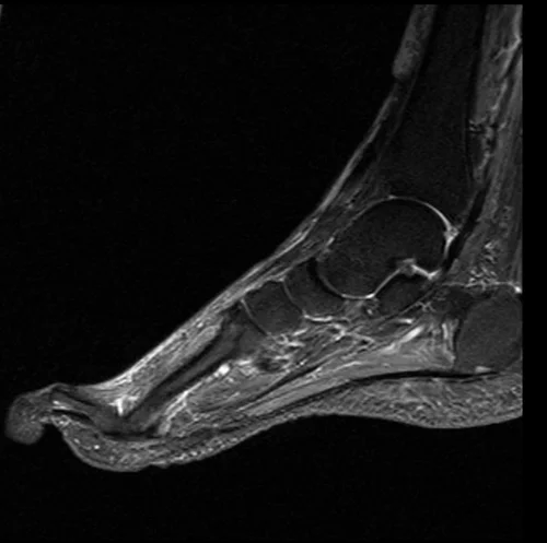 MRI FOOT SAGITTAL STIR IMAGE 2 - MRI