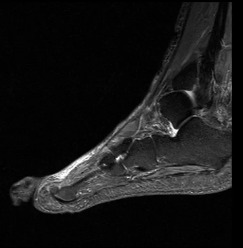MRI FOOT SAGITTAL STIR IMAGE 3 - MRI