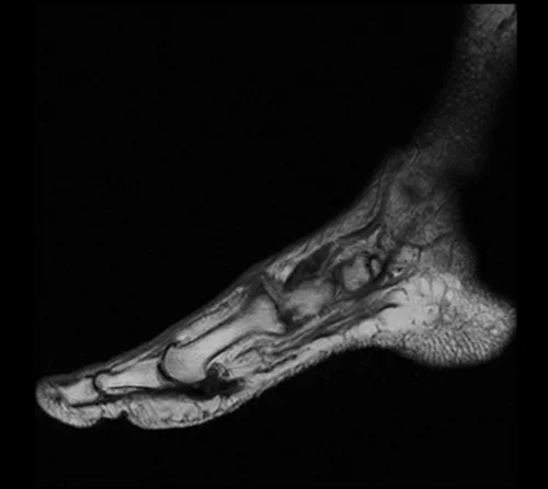 MRI FOOT SAGITTAL T1 IMAGE 1 - MRI