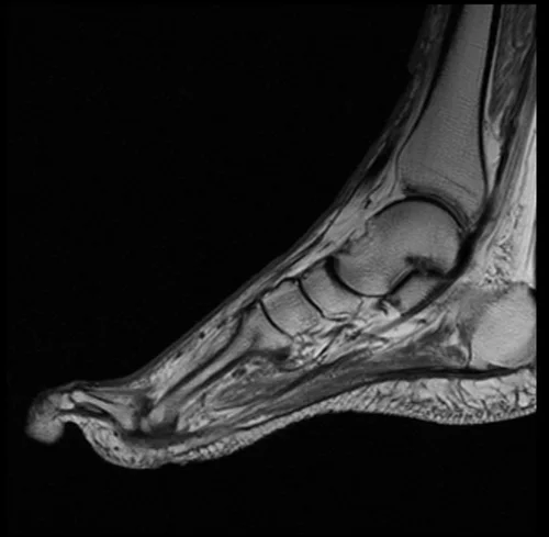 MRI FOOT SAGITTAL T1 IMAGE 2 - MRI