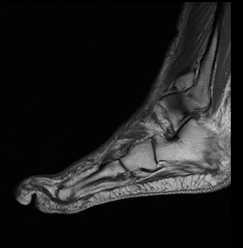MRI FOOT SAGITTAL T1 IMAGE 3 - MRI