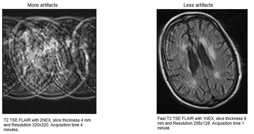 MRI Fast T2 TSE FLAIR with no motion artifacts