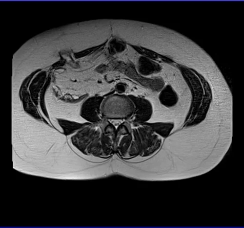 MRI Female Urethra axial t2 big fov image 1 - MRI