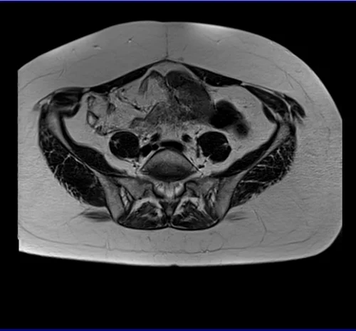 MRI Female Urethra axial t2 big fov image 2 - MRI