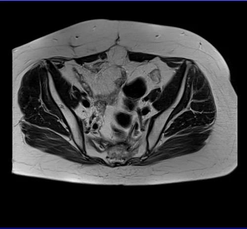 MRI Female Urethra axial t2 big fov image 3 - MRI