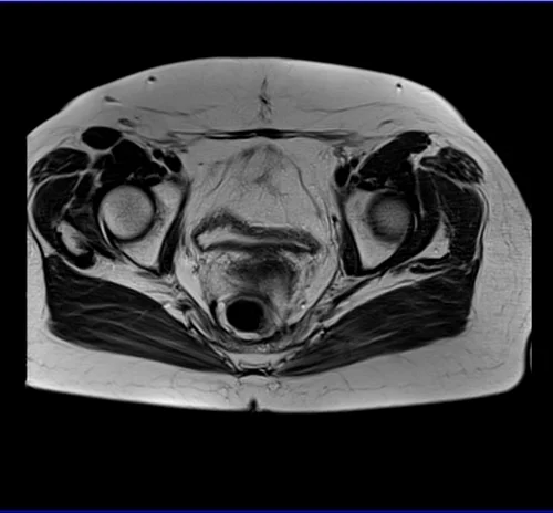 MRI Female Urethra axial t2 big fov image 4 - MRI