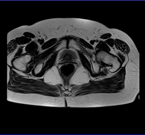 MRI Female Urethra axial t2 big fov image 5 - MRI