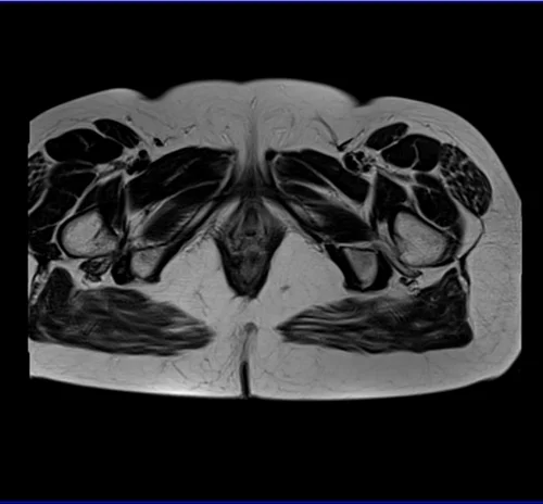 MRI Female Urethra axial t2 big fov image 6 - MRI