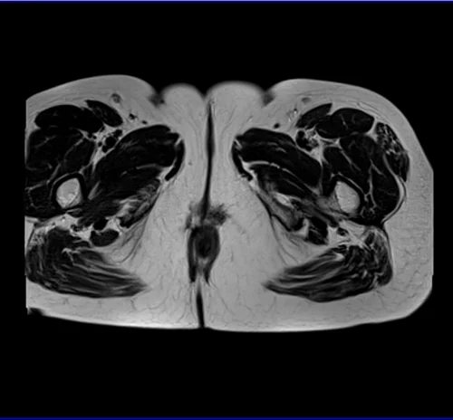 MRI Female Urethra axial t2 big fov image 7 - MRI