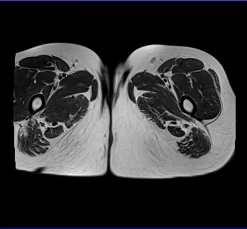 MRI Female Urethra axial t2 big fov image 8 - MRI