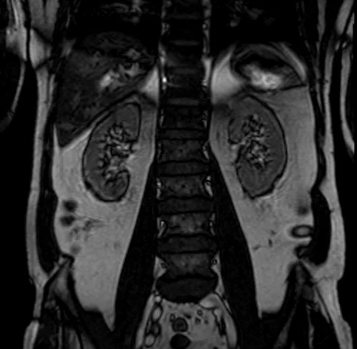 MRI KIDENYS LOCALIZER 2 - MRI