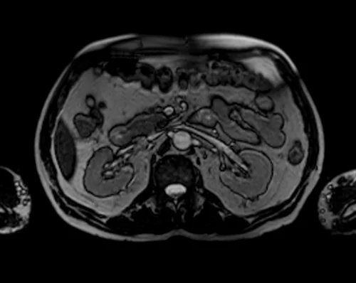 MRI KIDENYS LOCALIZER 3 - MRI