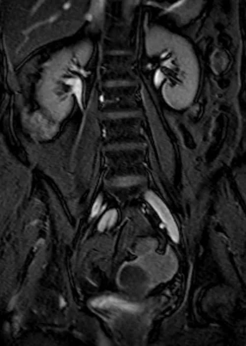 MRI KUB coronal TrueFISP fat sat image 3 - MRI