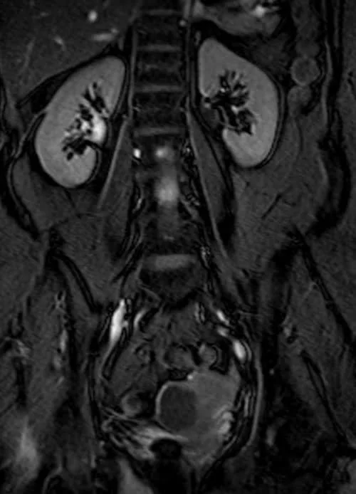 MRI KUB coronal TrueFISP fat sat image 4 - MRI