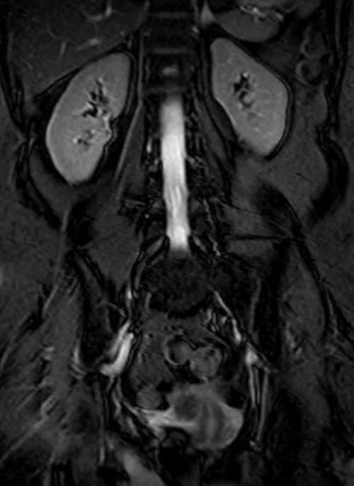 MRI KUB coronal TrueFISP fat sat image 5 - MRI