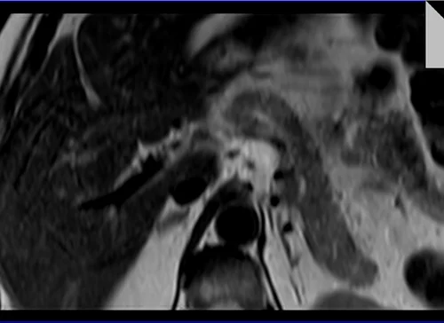 MRI PANCREAS T2 TSE AXIAL 1 - MRI