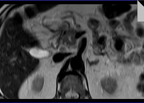 MRI PANCREAS T2 TSE AXIAL 2 - MRI