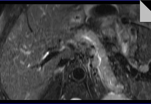 MRI PANCREAS T2 TSE AXIAL FAT SAT 1 - MRI