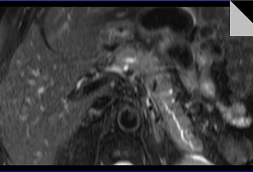 MRI PANCREAS T2 TSE AXIAL FAT SAT 2 - MRI