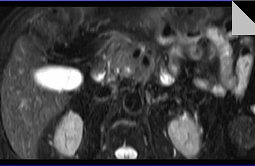 MRI PANCREAS T2 TSE AXIAL FAT SAT 3 - MRI