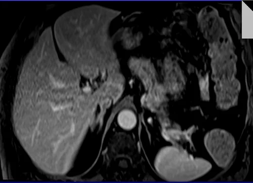 MRI PANCREAS TI VIBE 5 MIN 1 - MRI
