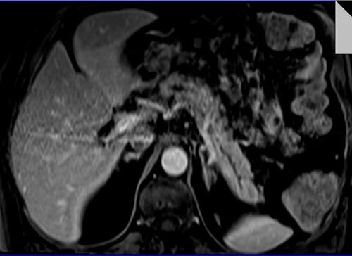 MRI PANCREAS TI VIBE 5 MIN 2 - MRI