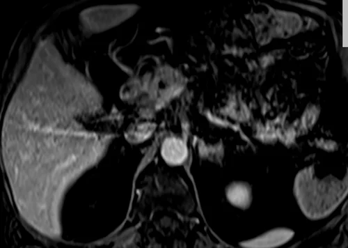 MRI PANCREAS TI VIBE 5 MIN 3 - MRI