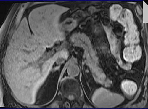 MRI PANCREAS TI VIBE PRE 1 - MRI