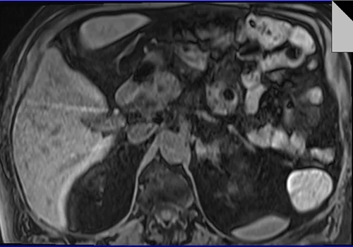 MRI PANCREAS TI VIBE PRE 3 - MRI