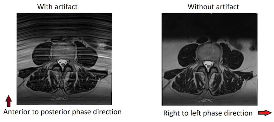 MRI Phase and frequency swap for Respiratory Motion artifacts