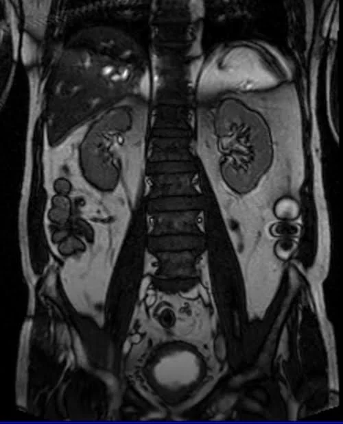 MRI UROGRAPHY LOC 1 - MRI