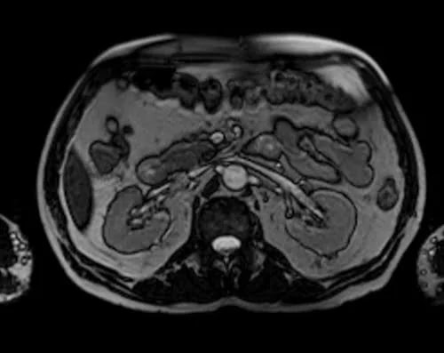 MRI UROGRAPHY LOC 2 - MRI