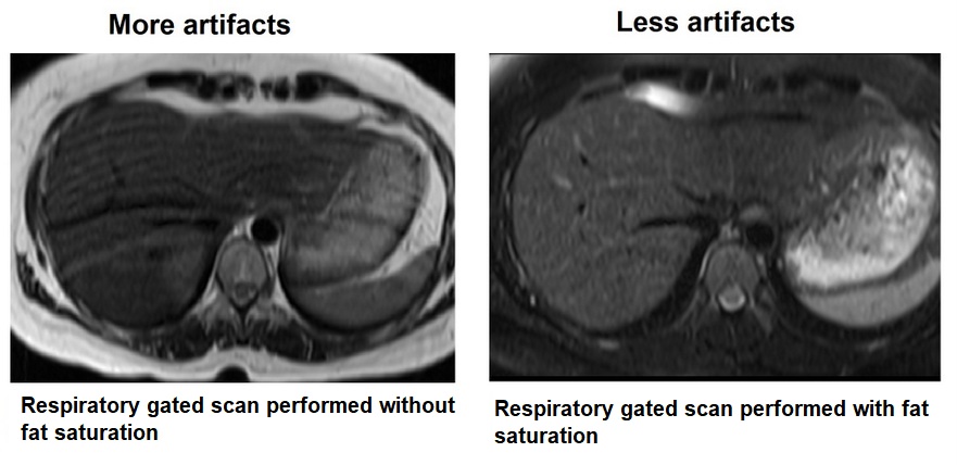 MRI artifacts and fat saturation