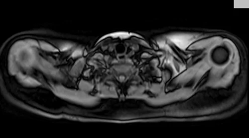 MRI chest axial t1 fat sat image 1 - MRI