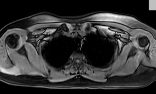 MRI chest axial t1 fat sat image 2 - MRI