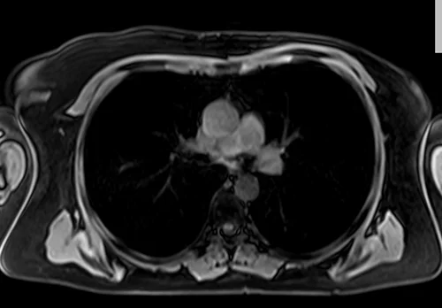 MRI chest axial t1 fat sat image 3 - MRI