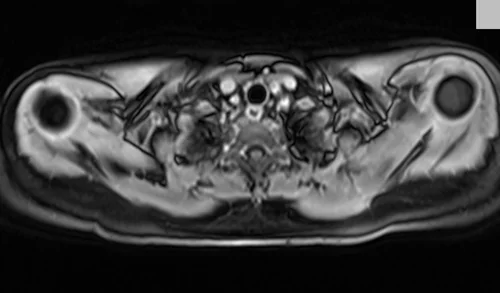 MRI chest axial t1 post contrast image 1 - MRI