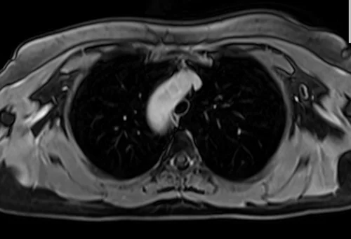 MRI chest axial t1 post contrast image 2 - MRI