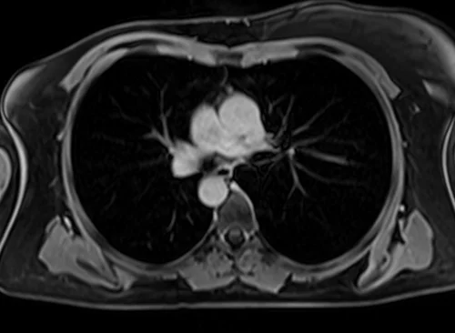 MRI chest axial t1 post contrast image 3 - MRI
