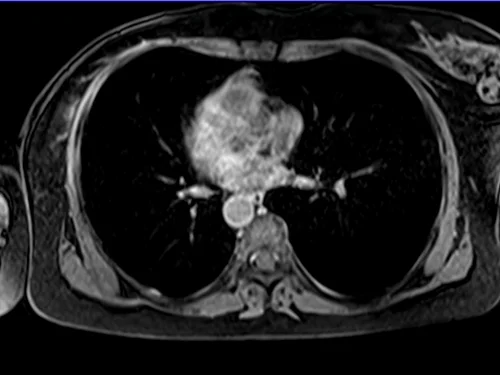MRI chest axial t1 post contrast image 4 - MRI