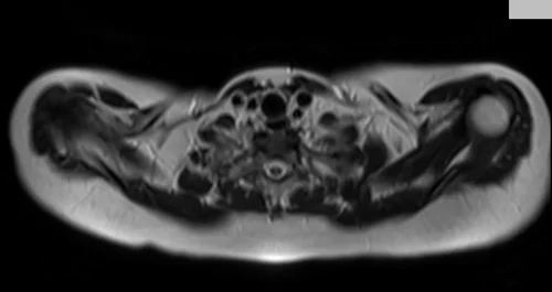 MRI chest axial t2 image 1 - MRI