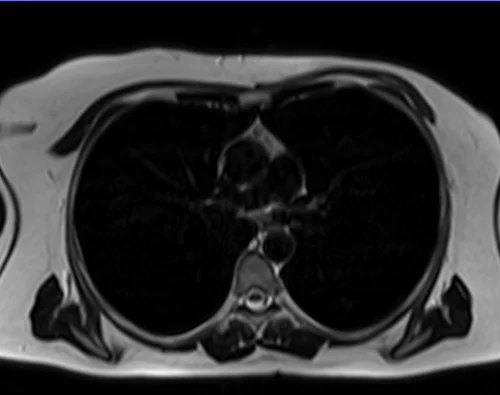 MRI chest axial t2 image 3 - MRI